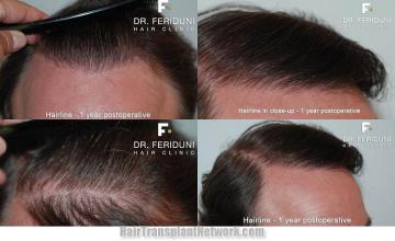 Hair transplantation surgery before and after pictures