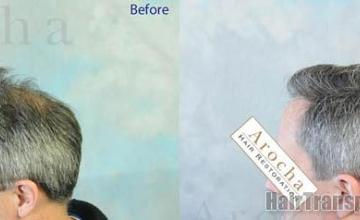 Hair transplantation surgery before and after pictures