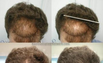 Hair transplant procedure before and after pictures