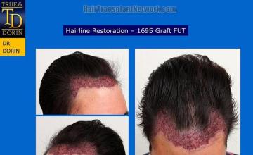 Hair restoration procedure before and after pictures