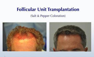 Hair transplant surgery before and after photos