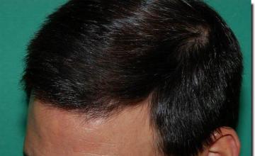 Hair restoration procedure results