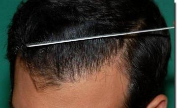 Hair restoration procedure results