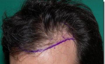 Hair restoration procedure results