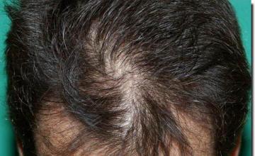 Hair restoration procedure results