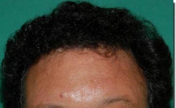 Hair restoration procedure results