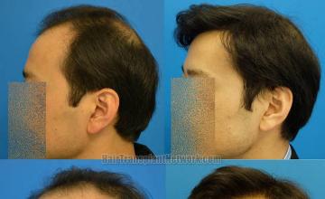 Hair transplantation surgery before and after pictures