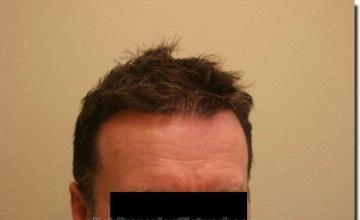 Hair restoration procedure results