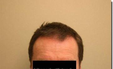 Hair restoration procedure results