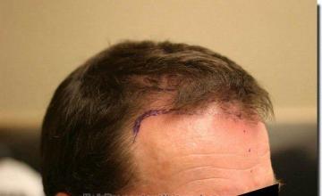 Hair restoration procedure results