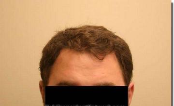 Hair restoration procedure results