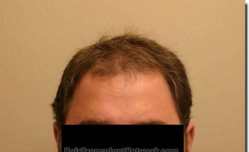 Hair restoration procedure results