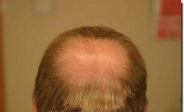 Hair restoration procedure results