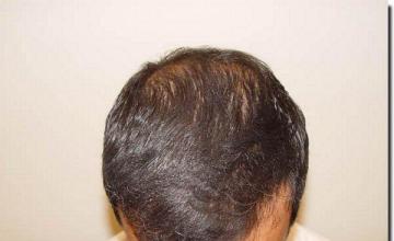 Hair restoration procedure results