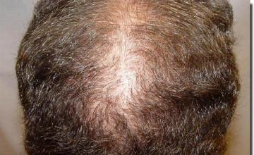 Hair restoration procedure results