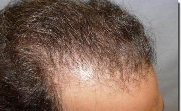 Hair restoration procedure results