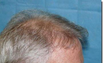 Hair restoration procedure results