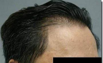 Hair restoration procedure results