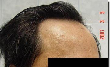 Hair restoration procedure results