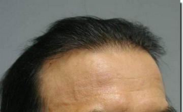 Hair restoration procedure results