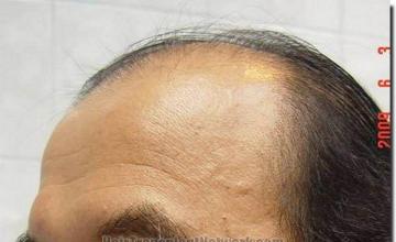 Hair restoration procedure results