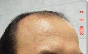 Hair restoration procedure results