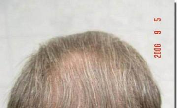 Hair restoration procedure results