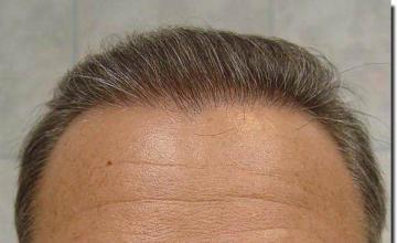 Hair restoration procedure results