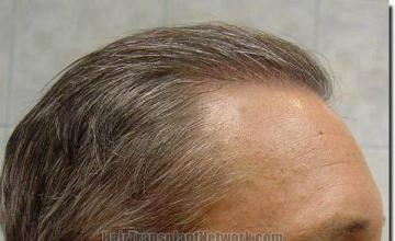 Hair restoration procedure results