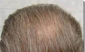 Hair restoration procedure results