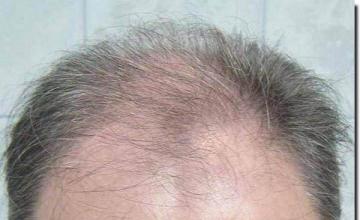 Hair restoration procedure results