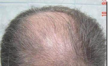 Hair restoration procedure results