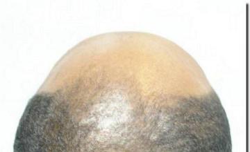 Hair restoration procedure results