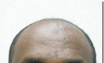 Hair restoration procedure results