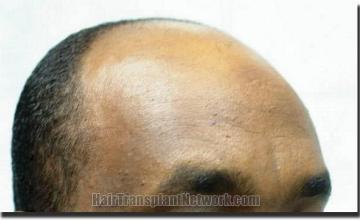 Hair restoration procedure results