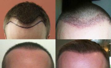 Hair restoration procedure before and after results