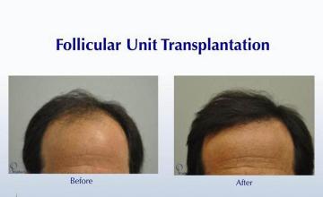 Hair restoration procedure before and after results