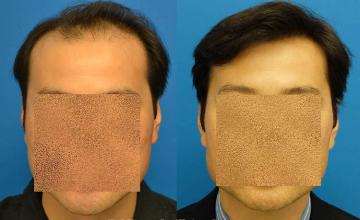 Hair restoration procedure before and after results