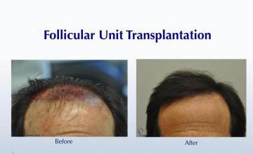 Hair restoration procedure before and after results