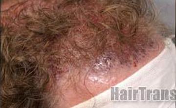 Hair transplantation surgery before and after images