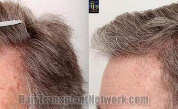 Hair transplantation surgery before and after images