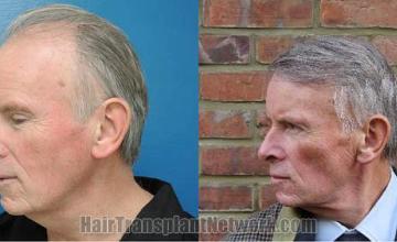 Hair restoration procedure before and after pictures