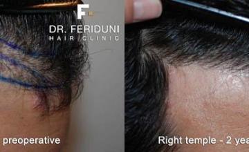 Hair restoration procedure before and after pictures