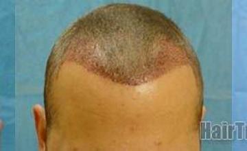 Hair restoration results from 2051 grafts viewed from the top