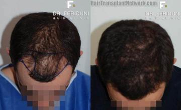 Before and after hair transplant procedure images