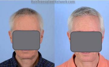 Hair transplantation surgery before and after photos