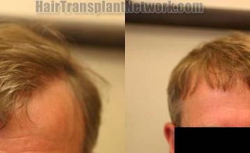 Hair restoration procedure before and after results