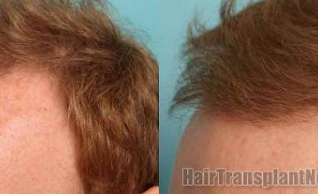 Hair transplantation surgery before and after images