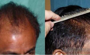 Right side view before and after hair restoration