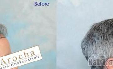 Hair transplantation surgery before and after photos